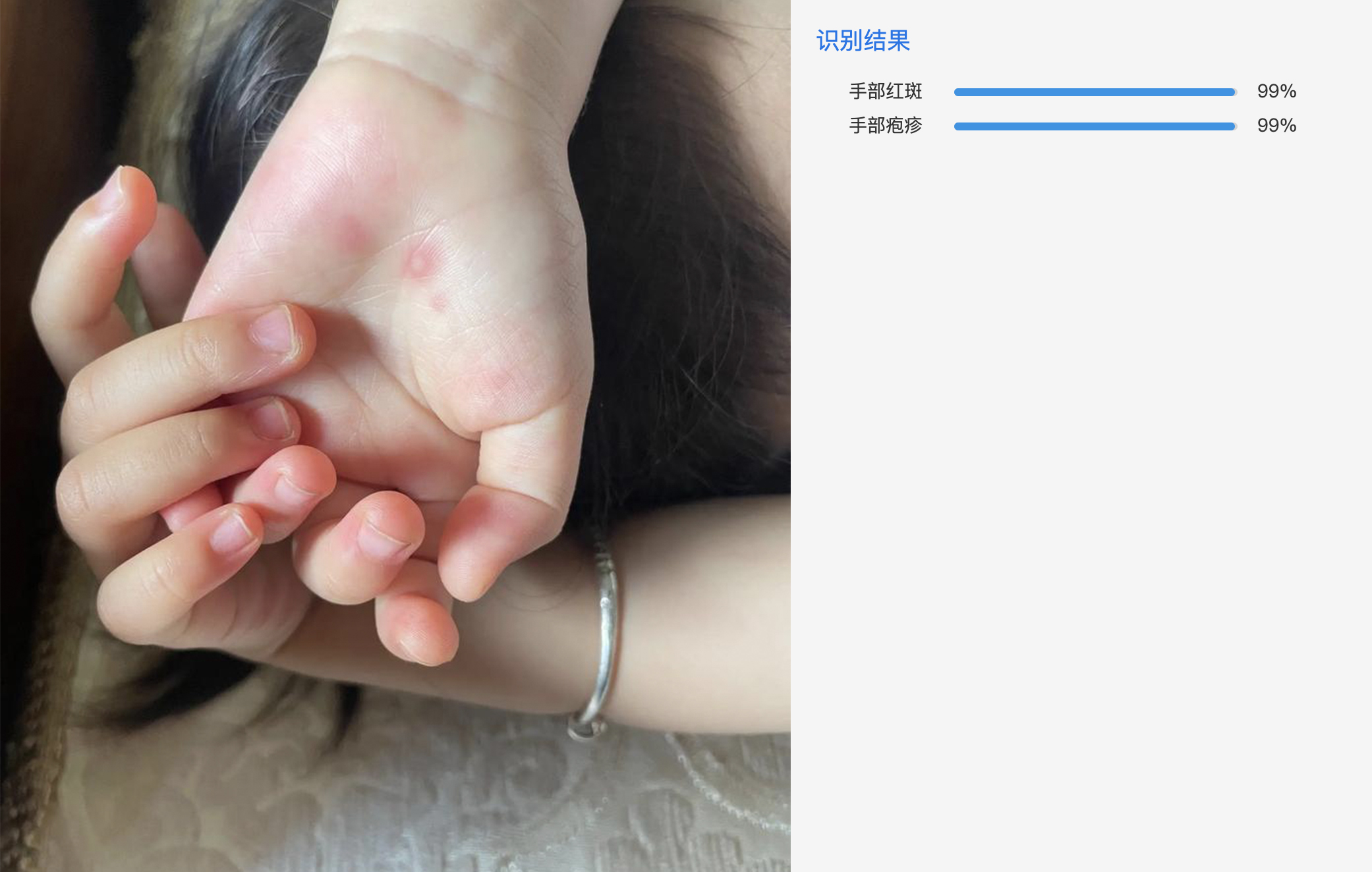 AI手足口检测 API 接口示意图